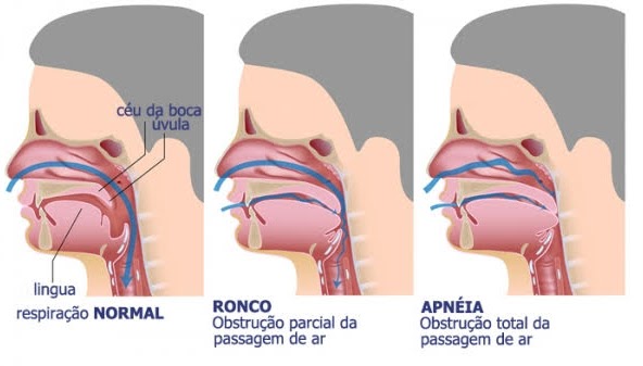 ronco e apneia