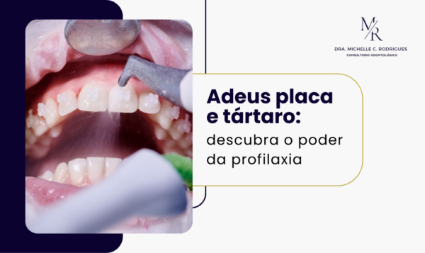 Adeus placa e tártaro: descubra o poder da profilaxia